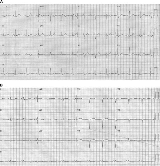 Figure 2. Electrocardiogram changes in AL amyloidosis. (A) Baseline electrocardiogram of an AL patient with no signs of cardiac involvement. (B) Follow-up study only months later demonstrates changes resulting from cardiac amyloidosis, including pseudo-infarct pattern, and Q waves and loss of voltage in the limb leads. Reprinted from Wright et al60 with permission.