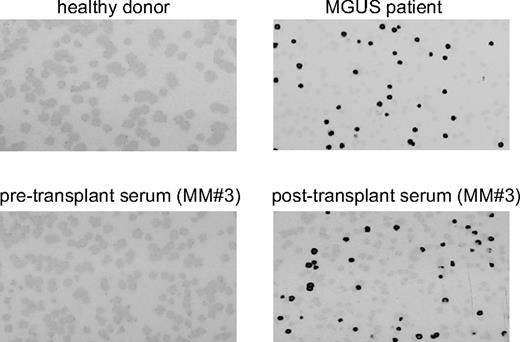 Figure 1. OFD1 IgG-antibody response in MGUS and posttransplantation MM patients detected by phage plaque assay. Detection of antibody reactivity to the OFD1 protein determined by phage-plaque assay in healthy donors, as well as MGUS and posttransplantation MM patients.