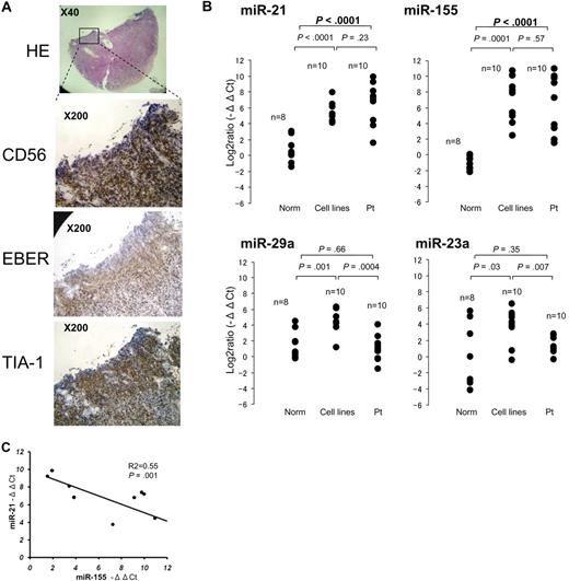 Figure 3. Quantitative PCR analysis of miRNA levels in specimens of primary NK-cell lymphoma/leukemia. (A) Histopathologic features of a typical specimen of primary extranodal NK/T-cell lymphoma, nasal type (NKpt5). Hematoxylin and eosin–stained (×40), CD56-stained, EBER-ISH–stained, and TIA-1-stained (×200) cells are shown. (B) Quantitative PCR analysis of mature miR-21, miR-23a, miR-29a, and miR-155 in normal sCD3−CD56+ cells (n = 8), NK-cell lymphoma/leukemia lines (n = 10), and specimens of primary NK-cell lymphoma/leukemia (n = 10). Y-axis: −ΔΔCt values for miRNA expression. The significance of differences between groups was evaluated by the use of the Student t test. (C) Correlation between miR-21 and miR-155 expression in 10 primary lymphoma/leukemia specimens. y-axis, −ΔΔCt values of miR-21 expression; x-axis, −ΔΔCt values miR-155 expression. The P value was calculated by simple regression analysis.