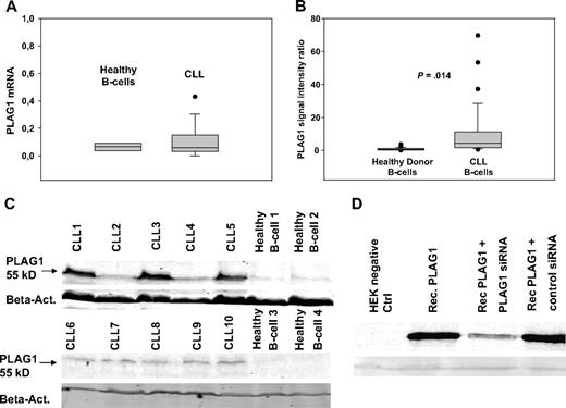 Figure 5. PLAG1 expression in CLL and healthy donor B cells. PLAG1 mRNA expression was assessed in CLL cells (n = 11) versus healthy donor control B cells (n = 8) by RT-PCR (A). PLAG1 protein expression was detected by immunoblotting of lysates from CLL cells and healthy donor B cells. Specificity of the PLAG1-specific mAb was proven in PLAG1-transfected HeLa cells (Rec.PLAG1) and cotransfection controls with PLAG1-specific siRNA (D). Protein expression in primary CLL cells (n = 29) and healthy donor B cells (n = 22) was assessed by immunoblotting of lysates with PLAG1-specific mAb and quantified by Odyssey densitometry. Two representative experiments are shown (B-C).