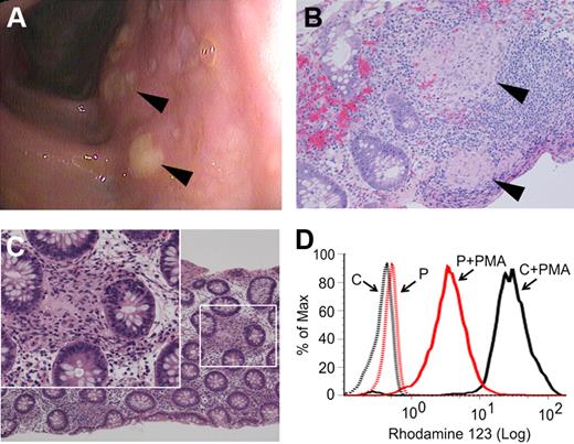 Figure 1. Findings of granulomatous colitis and partial reduction in neutrophil oxidase activity as measured by DHR123 assay. (A) Diffuse aphthous ulcerations () were visible throughout the colon at the time of presentation. Biopsies showed prominent epithelioid granulomata in lymphoid aggregates (B, ) and in lamina propria (C) with giant cells (inset). Four-μm sections were stained using hematoxylin and eosin prior to microscopy and photomicrographs were taken with a Nikon Eclipse 80i microscope equipped with a Nikon Digital Sight DS-U1 camera using 20×/0.50NA and 40×/0.75NA objectives. (D) DHR123 fluorescence in control (black line) and patient (red line) neutrophils before and after stimulation with 0.6 μg/mL PMA (representative of 5 assays).