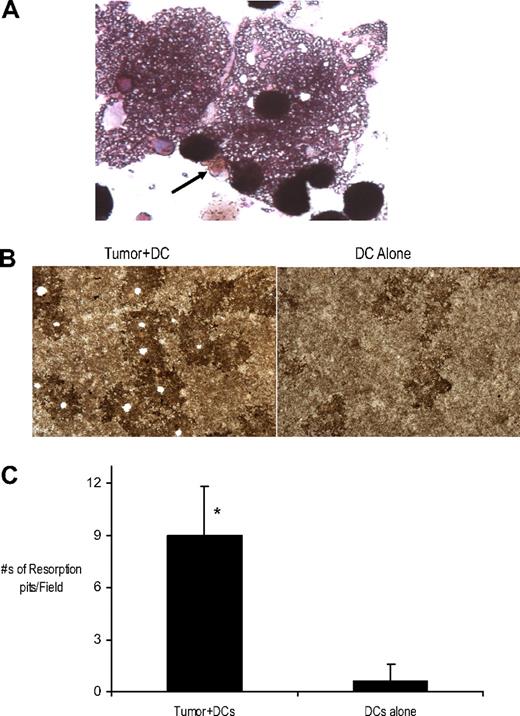 Figure 2. Characterization of MGCs present in myeloma-DC cocultures. (A) Tumor cells were cocultured with immature DCs at a tumor/DC ratio of 1:100 in methylcellulose cultures. Cells were harvested for cytospins after an incubation of 2 weeks and stained for TRAP activity Shown is a representative TRAP + MGC (↑). Original magnification, ×40. (B-C) Bone resorption activity of MGCs present in tumor-DC cocultures. Cells from the methylcellulose cultures of tumor + DCs or DCs alone were cultured on Biocoat osteologic discs for 2 weeks. (B) Appearance of resorbed bone (pits) after Von Kossa staining is shown. Original magnification, ×10. (C) Quantification of resorbed osteologic discs or pit area by light microscopy. *P < .05.