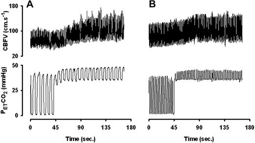 Figure 2. Representative continuous recordings of PETCO2 and CBF velocity (CBFV). (A) Healthy subject. (B) Sickle cell patient. In the patient, the increase in CBFV is less pronounced. Early leveling off for a comparable change in PETCO2 indicates a reduced cerebrovascular CO2 responsiveness.