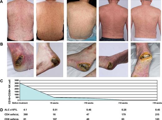 Figure 1. Measurement of CD16+CD56+ NK cells, lymphocyte count, and clinical features during treatment with alemtuzumab. Treatment of CNKL with alemtuzumab effectively improved livedo reticularis (A) and cutaneous ulcers (B), and this correlated with a decrease in CD16+CD56+ NK cells (C) and reconstitution of the total lymphocytes (D). ALC indicates absolute lymphocyte count.