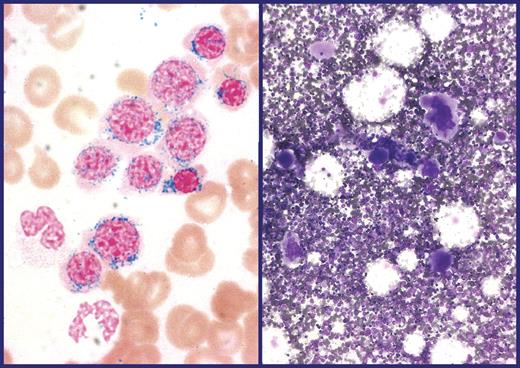 Figure 2. BM smears from a patient with RARS-T. (Left) BM ringed sideroblasts after Perls staining (100×/1.1 NA oil objective). (Right) BM smears showing atypical megakaryocytes (May-Grünwald/Giemsa staining, 10×/0.25 NA). Bone marrow smears were analyzed through an Axioscope 2 Plus microscope (Carl Zeiss). Images were acquired through an Axiocam MRc 5 camera (Carl Zeiss) and processed through Axiovision release 4.6.3 imaging solution software (Carl Zeiss). Reproduced from Hellström-Lindberg and Cazzola.24 (Appendix: color figures at http://asheducationbook.hematologylibrary.org/cgi/content/full/2008/1/491.)