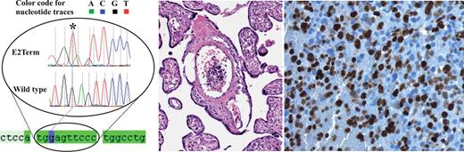 Figure 1. Alignment of the selected region of the GATA1 sequence for control cells and blasts cells harboring the E2Term mutation leading to a stop codon in codon 2. (Left) The star indicates the position of a homozygous replacement of the first nucleotide of codon 2 (labeled G in violet) by a T. Below, a part of the GATA1 sequence mRNA is imprinted as light green and the coding region as dark green. (Middle and right) Placental specimen with high numbers of blasts in the fetal vessels in the placental villi with massively elevated proliferation rate in the MIB1 staining, diagnostic for TMD.