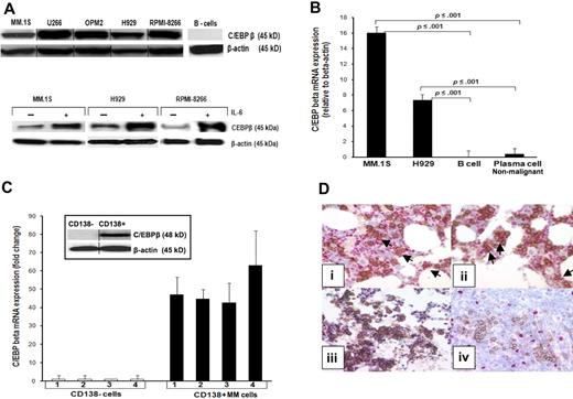 Figure 1. C/EBPβ is highly expressed in MM cells. (A top panel) Expression of C/EBPβ in MM cell lines was detected by Western blotting as described in “Western blot analysis.” β-Actin was used as a loading control for all samples. (A bottom panel) Induction of expression of C/EBPβ by IL-6. Cells were cultured in 1% FBS with or without IL-6 for 48 hours, and analyzed for C/EBPβ protein expression. (B) C/EBPβ mRNA expression in MM.1S and H929 MM cell lines, B cells, and nonmalignant plasma cells were analyzed by quantitative RT-PCR. Data were analyzed according to the ΔCT method. The results are expressed as C/EBPβ mRNA expression relative to β-actin. B cells were cultured in a cocktail of CD40 and human IgM for 6 days for the differentiation into plasma cells. Expression of CD19 of B cells as well as CD38 for plasma cells was confirmed by flow cytometry. (C) Mononuclear cells of bone marrow samples of 4 MM patients were collected by Ficoll. CD138+ and CD138− cells from the same patient were separated using magnetic-activated cell sorting beads selection. The total RNA was extracted, subjected to cDNA synthesis, and used for quantitative RT-PCR. Results are depicted as C/EBPβ mRNA fold expression in CD138+ cells compared with CD138− cells. The level of mRNA was normalized to β-actin expression. Expression of C/EBPβ and IRF4 was detected by Western blotting with anti-C/EBPβ and anti-IRF4 in CD138+ cells and CD138− cells from the same patient. β-Actin was used as a loading control. Error bars indicate SD of the mean. (D) Immunohistochemical double staining was performed on paraffin-embedded MM bone marrow trephines to detect C/EBPβ expression in CD138+ cells. Images were obtained using an Olympus 1 X70 microscope equipped with a 20×/0.40 numeric aperture objective lens (Olympus) and were acquired through Magnafire Version 4.1 software (Optronics). Positive staining shows a red nucleus for C/EBPβ and brown membrane for CD138. Positive double staining is indicated in panels Di and ii by arrows, negative double staining is shown in panel Diii. Nonneoplastic plasma cells in palatine tonsils did not show a C/EBPβ expression (Div). Vertical lines have been inserted to indicate a repositioned gel lane.