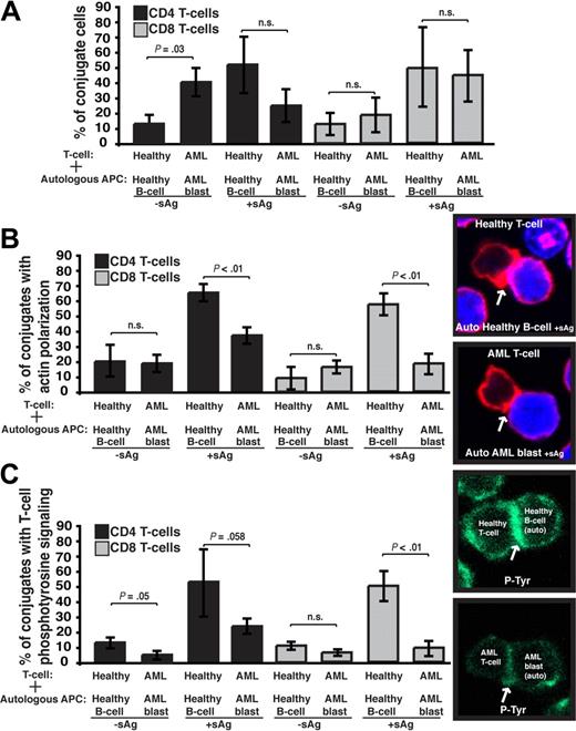 Figure 3. AML T cells are able to conjugate effectively with autologous AML blasts but show impaired immune synapse formation and recruitment of T-cell signaling molecules. T cells from AML patients or age-matched healthy donors (healthy) were allowed to conjugate with autologous (auto) AML or healthy autologous B cells, respectively, ± sAg acting as APCs (CMAC dyed, blue). Conjugates were then fixed, stained, and scored by visual counting using confocal microscopy. (A) Percentage of T-cell–forming conjugates. (B) Percentage of T-cell conjugates resulting in F-actin (rhodamine phalloidin, red) polarization. (C) Percentage of T-cell conjugates resulting in phosphotyrosine polarization (P-Tyr, green) at the T-cell immune synapse. Data are the mean ± SD from 10 independent experiments with 50 conjugates analyzed per experiment. Arrows indicate protein localization at the T-cell–APC synapse site. Original magnification × 63. Statistical differences between experimental groups were evaluated by 2-tailed Student t test. P < .05 was considered statistically significant.