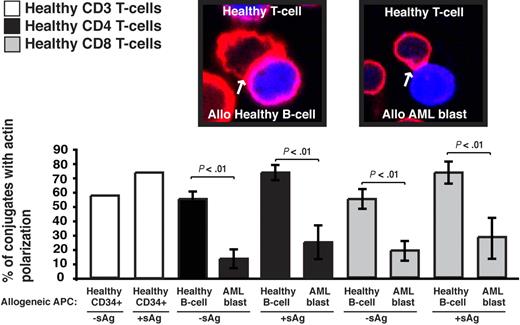 Figure 4. AML blasts exhibit defective APC function with healthy T cells in mixed allogeneic experiments. Healthy T cells were allowed to conjugate with allogeneic (allo) healthy CD34+ cells, healthy B cells, or AML blasts ± sAg acting as APCs (CMAC dyed, blue). Conjugates were then fixed and stained with rhodamine phalloidin to detect F-actin (red). Conjugates were selected at random for imaging and were scored for F-actin polarization at the immune synapse. Each dataset is the mean ± SD from 10 independent patient experiments with at least 50 conjugates analyzed per experiment. Arrows indicate F-actin accumulation at the T-cell–APC synapse site. Note the equivalent APC function of healthy B cells and healthy CD34+ cells acting as control cells. Original magnification × 63. Statistical differences between experimental groups were evaluated by 2-tailed Student t test. P < .05 was considered statistically significant.