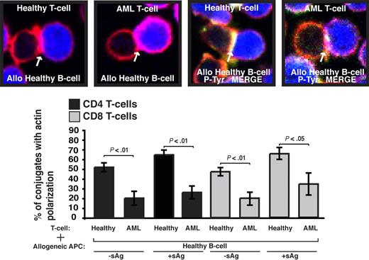 Figure 5. AML T cells exhibit impaired immunologic synapse formation with healthy APCs in mixed allogeneic experiments. T cells from AML patients or age-matched healthy donors (healthy) were allowed to conjugate with allogeneic (allo) healthy B cells ± sAg acting as APCs (CMAC dyed, blue). Conjugates were then fixed, stained, and scored for F-actin (rhodamine phalloidin, red) polarization at the T-cell immune synapse. Data are the mean ± SD from 10 independent experiments with 50 conjugates analyzed per experiment. Arrows indicate protein localization at the T-cell–APC synapse site. Colocalization of F-actin (red) and phosphotyrosine (P-Tyr, green) in the upper right merge images is shown in yellow. Original magnification × 63. Statistical differences between experimental groups were evaluated by 2-tailed Student t test. P < .05 was considered statistically significant