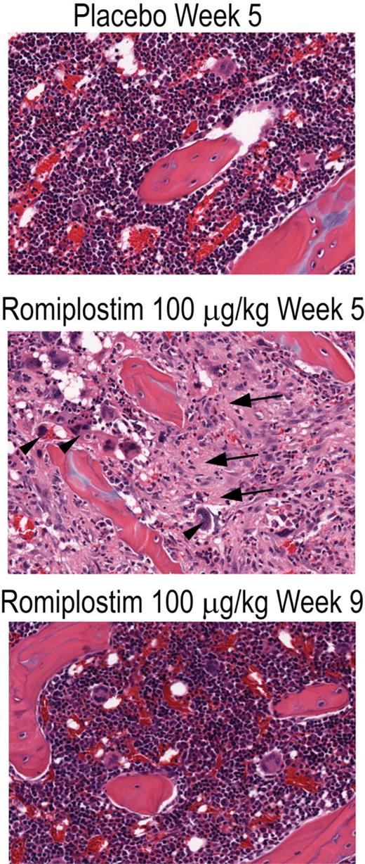 Figure 1. Romiplostim produced a dose-dependent increase in bone marrow fibrosis in rats. Photomicrograph of hematoxylin and eosin–stained bone marrow sections (original magnification ×20) of rat femurs from placebo-treated animals (Placebo Week 5), from animals treated for 4 weeks with romiplostim (Romiplostim 100 μg/kg Week 5), and from animals treated for 4 weeks with romiplostim followed by 4 weeks without treatment (Romiplostim 100 μg/kg Week 9). Areas of increased collagen fibrosis (arrows) and increased megakaryocytes (arrowheads) are indicated.