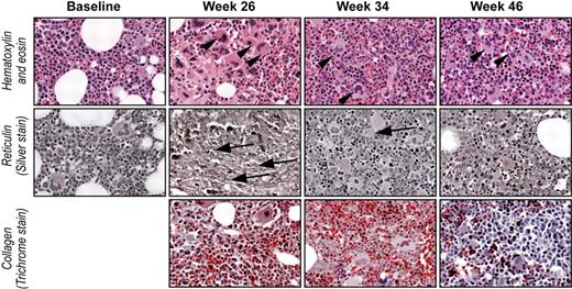 Figure 2. Improvement in bone marrow reticulin after cessation of romiplostim treatment. Photomicrographs (original magnification ×20) of bone marrow biopsies from patient 4 before romiplostim treatment (Baseline), during treatment (Week 26), and after discontinuation of treatment (Week 34 and Week 46). Sections stained with hematoxylin and eosin, reticulin, and trichrome stains as indicated. Megakaryocytes (arrowheads) were increased at baseline, markedly increased by week 26, and returned to baseline number by weeks 34 and 46. Reticulin (arrows) increased from grade 0 at baseline to grade 2/3 by week 26 followed by a decrease to grade 1 by week 46. Collagen fibrosis (trichrome stain) was not detected at any time. Blasts were not increased at any time.