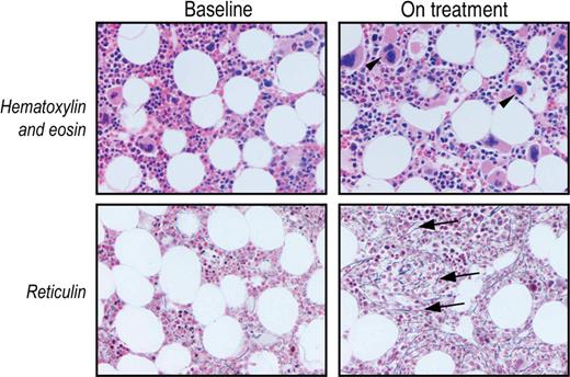 Figure 3. Bone marrow reticulin increased in one romiplostim-treated patient in the prospective study. Photomicrograph (original magnification ×20) of patient 11 before (Baseline) and after 3.2 months of romiplostim treatment (On treatment). The on-treatment bone marrow sample exhibited an increased number of megakaryocytes (arrowheads) and reticulin (grade 1-2; arrows) but no increase in cellularity.