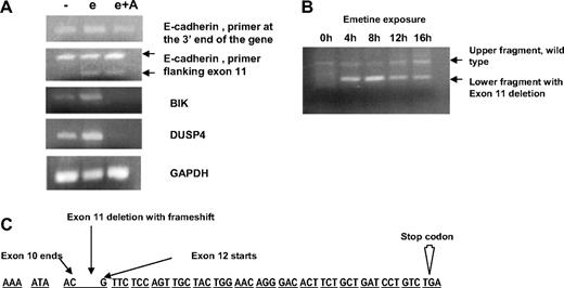 Figure 1. Analysis of exon 11-skipped transcript. (A) RT-PCR analysis of untreated chronic lymphocytic leukemia (CLL) cells and cells treated with emetine (e) or emetine plus actinomycin D (e + A) and assayed for expression of E-cadherin, BIK, and DUSP4. In the top panel, E-cadherin cDNA was amplified with primers at the 3′ end of the gene, In the bottom panel, the E-cadherin cDNA is amplified by primers in the region of exons 10 and 12. The upper points toward the band of expected size, and the lower points toward a DNA fragment lacking exon 11. The next 2 panels show amplification of BIK and DUSP4. Glyceraldehyde-3-phosphate dehydrogenase amplification shown as a control. (B) Time course of emetine-induced up-regulation of E-cadherin RNA. CLL cells treated with emetine for 0, 4, 8, 12, and 16 hours. Primers in the region of exons 10 and 12 were used for amplification of E-cadherin cDNA and give rise to 2 fragments that differ by 146 base pairs in emetine-treated cells due to exon 11 deletion. (C) Sequence of the E-cadherin gene in the region of interest. There is an exon 11 deletion resulting in a frame shift and PTC codon.
