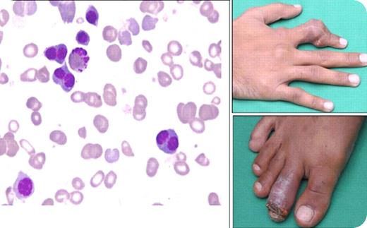 A 22-year-old man presented with longstanding history of pallor and intermittent transfusion support since the age of 10. Family history was significant with his elder brother having longstanding history of transfusion-dependent anemia, and his parents had consanguineous marriage. Examination revealed pallor, icterus, splenomegaly, and severe gouty tophi leading to deformity of fingers of the right hand (top right) and an ulceration of a toe (bottom right). / Complete blood count showed hemoglobin, 53 g/L; hematocrit 0.17 L/L; MCV 80.2 fL, white cell count 5.9 × 109/L, and platelets 395 × 109/L. On the peripheral blood smear, there was anisocytosis, polychromasia, and numerous nucleated red blood cells. Bone marrow examination (shown on the left) revealed numerous binucleated and multinucleated erythroid precursors, typical of congenital dyserythropoietic anemia type II. Hemoglobin electrophoresis showed normal levels of HbA and HbA2 and no elevation of HbF. Blood chemistry revealed raised indirect bilirubin of 2.8 mg/dL and uric acid of 16.7 mg/dL. None of the family members including the elder brother with transfusion-dependent anemia have gout. / Although gout can be associated with hemolytic anemia, the degree of severe tophaceous gout in this patient is quite unusual.