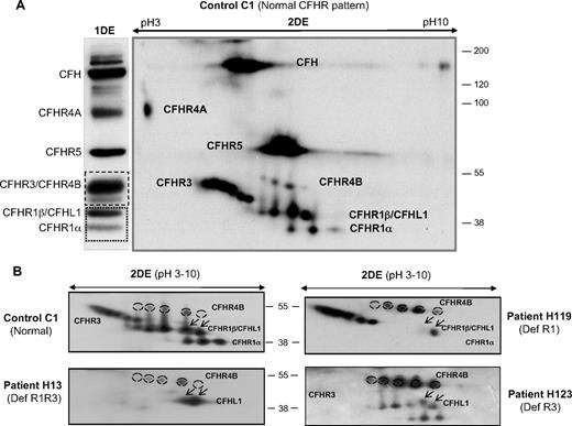 Figure 4. Analysis of CFHR proteins by 2-DE. (A) Western blots obtained after monodimensional (1DE) or 2-dimensional (2DE) electrophoresis of the heparin-sepharose eluate corresponding to control person C1, showing the Normal CFHR pattern. A single antibody solution containing equivalent amounts of the individual αCFHR1, αCFHR3/4, and αCFHR5 antibody preparations was used. The position and size (in kDa) of molecular weight markers is also indicated. (B) Two-dimensional analysis of CFHR1/CFHL1 and CFHR3/CFHR4B isoforms in control sample C1 and in 3 patients with aHUS showing the CFHR patterns DefR1R3, DefR1, or DefR3. CFHR4B isoforms are surrounded by dotted circles. Arrows indicate CFHL1 isoforms. The theoretical isoelectric points calculated with Compute pI/molecular weight program at ExPASy server (http://ca.expasy.org/tools/pi_tool.html) were CFH (6.12), CFHL1 (6.77), CFHR1 (7.53), CFHR3 (7.79), CFHR4A (4.85), CFHR4B (5.16), and CFHR5 (6.87).