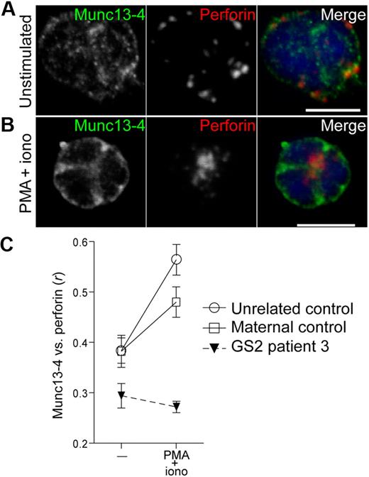 Figure 4. NK cells isolated from a GS2 patient are impaired in the ability to recruit Munc13-4 to polarized perforin granules in PMA/ionomycin-activated cells. Resting NK cells were isolated from a patient, a healthy heterozygous parent, and a healthy donor, then were incubated alone or stimulated with PMA and ionomycin for 20 minutes at 37°C, followed by fixation, permeabilization, and labeling with anti-Rab27a polyclonal antibody and anti-perforin mAb. Confocal images of single, representative resting (A) and PMA/ionomycin-stimulated (B) Rab27a-deficient cells are shown, with scale bars representing 5 μm. (C) Colocalization of perforin with Munc13-4 was calculated as Pearson correlation coefficient, r, using the JACOP plugin in ImageJ. Ten to 15 cells per condition were analyzed. Mean values are plotted; error bars represent SD.
