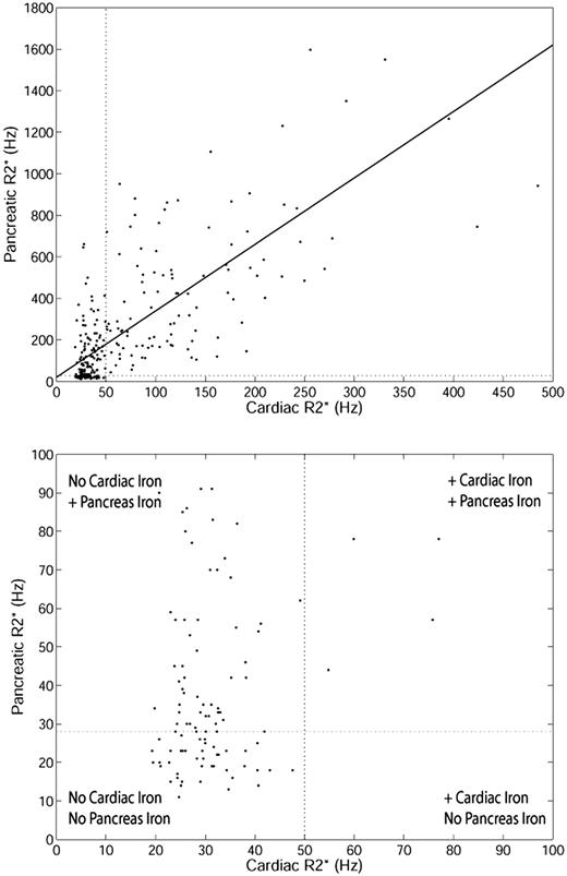 Figure 1. Relationship between cardiac R2* and pancreatic R2* for TM patients. (Top) Linear fit is shown (r2 = 0.52, P < .001) over the whole range. Upper limit of normal pancreatic R2* (28.1 Hz) and cardiac R2* (50 Hz) is shown for reference. (Bottom) Zoomed view of patients with cardiac R2* and pancreatic R2* less than 100 Hz.