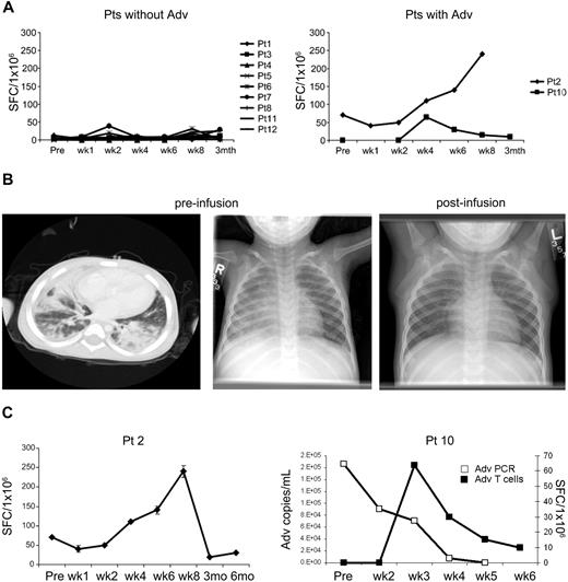 Figure 5. Effects of adenovirus-specific CTL in vivo. (A) ELIspot analysis of the frequency of peripheral blood T cells responding to irradiated Ad5f35-infected donor PBMCs by IFN-γ secretion before and after CTL infusion in patients without (n = 9; left panel) and with (n = 2; right panel) adenovirus infection at the time of receiving CTL. (B) Imaging studies are shown before and after CTL in a patient (patient 2) with adenovirus pneumonia who had a complete clinical response after T-cell infusion. A chest CT scan and chest radiograph demonstrate bilateral interstitial infiltrates. The follow-up chest radiograph 2 weeks after CTL infusion is reported as normal (C). Marked increase in adenovirus-specific T-cell precursor frequency in patient 2, and marked decrease in adenoviral load in stool from patient 10 after CTL infusion and clearance of virus coincident with a transient increase in adenovirus-specific T cells.