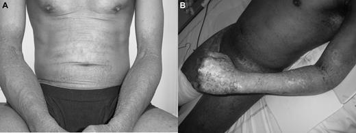 Figure 1. Photographs show patient at leukemic conversion phase of ATLL (A) and 5 days after methotrexate injection (B).