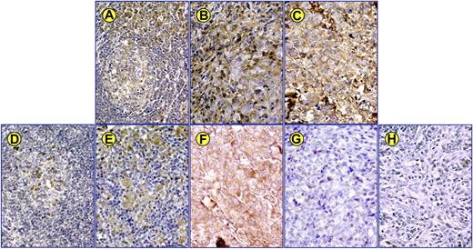 Figure 3. Expression of IGF-IR and IGF-I in primary tumors from ALK+ ALCL patients. (A) Immunohistochemical staining of sections from a reactive lymph node shows that IGF-IR is weakly expressed in germinal center lymphocytes. The expression of IGF-IR is more pronounced in small lymphocytes and plasma cells in the mantle zone (400×). Of 12 ALK+ ALCL tumor samples, 10 demonstrated significant levels of expression of IGF-IR. Examples of 2 positive tumors are shown in panels B and C. (D) Immunohistochemical study of a reactive lymph node shows very low levels of expression of IGF-I in scattered small lymphocytes and plasma cells. Eight of 12 ALK+ ALCL tumors showed the expression of IGF-I. Two positive cases are illustrated in panels E and F. (E) The large infiltrating tumor cells are positive for IGF-I, and the background small benign lymphocytes are negative. (F) Lymph node architecture is replaced by tumor cells that are strongly positive for IGF-I. (G-H) Illustrated are 2 ALK+ ALCL cases where the lymphoma cells are negative for IGF-I.