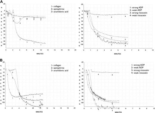 Figure 2. Platelet aggregation in patients with CML in chronic phase receiving therapy with dasatinib or imatinib. Aggregation was recorded as increase in light transmission. Traces shown are representative of several independent tests with blood obtained from different patients treated with either dasatinib (A) or imatinib (B). Dasatinib was frequently associated with decreased response to arachidonic acid and epinephrine.