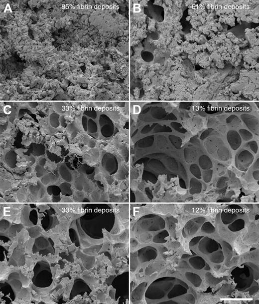 Figure 5. Comparison of lung lesions in normal and neutropenic mice infected with S pyogenes. Scanning electron micrographs of representative mouse lung tissue sections are shown. Normal (A,C,E) or neutropenic (B,D,F) mice were injected intraperitoneally with (A-B) 5 × 106 CFU S pyogenes, (C-D) 5 × 106 CFU S pyogenes, and 200 μg HKH20 (E-F) 5 × 106 CFU S pyogenes and 50 μg aprotinin. Bar represents 50 μm.