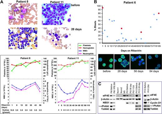 Figure 1. Ribavirin treatment targets eIF4E activity and localization in patients. (A) Top panels show bone marrow specimens for patients 8 (touch print, due to dry aspirate) and 11 (squash preparation) prior to therapy. Note the abundance of blasts. Immediately below, panels show response after 28 days of therapy. Patient 8 achieved PRi and patient 11, a CR. Both exhibit a restoration of hematopoiesis. This is reflected in the improvement in peripheral blood counts, particularly platelets and neutrophils, as shown in the graphs in the bottom panels. Hydrea levels are shown below the graphs indicating that response did not depend on hydrea. As well, white blood cell (WBC) counts remained normal despite decreasing hydrea doses. Squash preparations of bone marrow aspirates and touch prints of bone marrow biopsies were air-dried and stained with Wright-Giemsa. The Leica DM2 LB2 microscope with the Leica H3X PL Fluotar 100× objective lens 1.3 numeric aperture (Leica) and oil immersion were used to examine the specimens. The Infinity 1-3C (color) camera was used to capture images on the Infinity Analyze image acquisition software (Lumenera Corporation). (B, top panel) Ribavirin treatment lowered blast counts. Plot of percentage of peripheral (blue) or bone marrow (red) blasts versus treatment day for patient 6. (Bottom panel) Ribavirin treatment led to relocalization of eIF4E. Immunohistochemistry was carried out as described where cells were stained for eIF4E and DAPI.1,13 Cells were immunostained with an eIF4E mAb directly conjugated to FITC (BD Bioscience). Specimens were mounted in Vectashield with DAPI (Vector Laboratories). Channels were recorded separately with no cross talk observed between channels. Micrographs were collected on a laser scanning confocal microscope (LSM510; Carl Zeiss) using a 100× objective with a numeric aperture of 1.4, with 2× digital zoom at room temperature. Images were displayed using Photoshop CS2 (Adobe). Micrographs represent single optical sections through the plane of the cell. (C) eIF4E activity and levels were reduced by ribavirin treatment in patients. Western blot analysis was carried out using the antibodies indicated. Antibodies for immunoblotting were obtained from Cell Signaling unless otherwise mentioned: mAb anti-eIF4E (BD Bioscience); pAb anti-NBS; pAb anti–cyclin D1 (Santa Cruz Biotechnology); pAb anti-Akt; anti–phospho Thr308 or Ser473 Akt; and mAb anti-β-actin (AC-15; Sigma -Aldrich). As expected, similar reductions were seen for either Thr308 or Ser473 phosphorylation of Akt as seen in cell culture.11