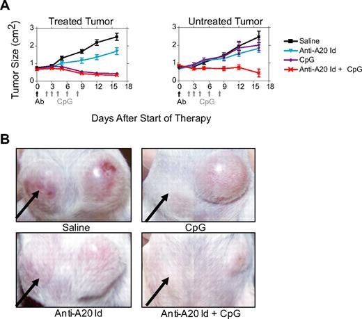 Figure 6. Anti-A20 Id + CpG combination therapy can mediate tumor destruction at local and distant tumor sites. (A) Balb/c mice were inoculated with 107 A20 cells subcutaneously on2 different locations on the abdomen. Therapy was administered when tumors were 1 cm2 (day 0). Anti-A20 Id mAb was administered intraperitoneally on day 0, and CpG was administered intratumorally on days 2, 3, 4, 6, and 8 in only a single tumor (P < .001). Each line is representative of a group consisting of 10 mice. (B) Photographs were taken of mice shown (on day 15) in panel A demonstrating that anti-A20 Id mAb + CpG combination therapy was superior to CpG or antibody alone in inhibiting the growth of both treated and untreated A20 tumors. ↑ points to the treated tumor.