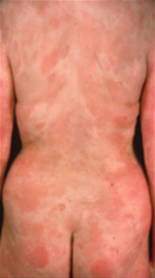 Figure 2. Patient with stage IB disease with patches and thin plaques.