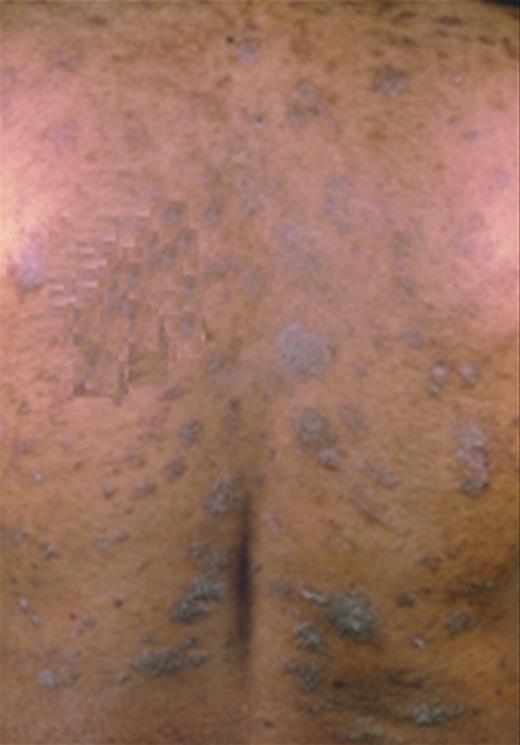 Figure 3. Patient with stage IB disease with folliculotropic plaques on the trunk.