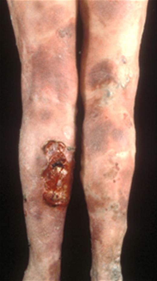 Figure 4. Patient with stage IIB disease with large tumor on the left calf.