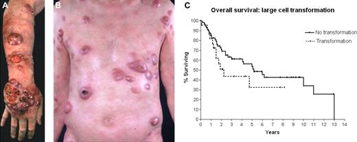 Figure 5. Patient with MF with transformed disease. (A) On limbs. (B) On trunk. (C) OS of patients with advanced-stage disease according to the presence (n = 22) or absence (n = 70) of large-cell transformation in the advanced-stage population.9 Median OS in the transformed group was 2.2 years, compared with 5.2 years in the nontransformed group.