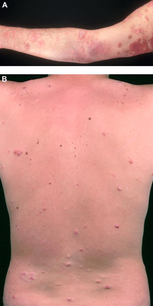 Figure 6. Patient with patches and plaques of MF (stage IB) on the limbs and self-healing papules and nodules of lymphomatoid papulosis on the trunk.