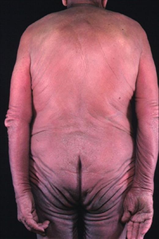 Figure 7. Patient with SS with erythrodermic disease.