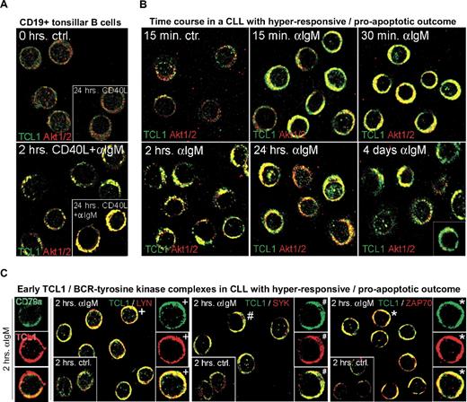 Figure 4. Growth responses of CLL cultures to BCR engagement correlate with kinetics of TCL1 and AKT colocalization to BCR membrane activation complexes. Confocal microscopy on primary cultures was done using a TCL1 monoclonal antibody (fluorescein isothiocyanate, green) in combination with AKT1/2, LYN, ZAP70, or SYK polyclonal antibodies (Cy3, red). Depicted are images from the 2-hour time point (C-E), which best distinguishes pAKT responders and correlated most strongly with the differential growth response seen at 48 hours, as in Figure 3A. (A) In tonsillar B cells, TCL1 and AKT showed a predominantly cytoplasmic distribution without apparent colocalization at baseline (or with CD40L stimulation), but recruitment of TCL1 and AKT to membrane complexes after continuous BCR engagement. AKT/TCL1 colocalization had a punctate pattern at 2 hours, with uniform membrane staining at 24 hours. (B) A representative CLL case with a hyperresponsive growth pattern showed a similar rapid localization of TCL1 and AKT to the membrane as early as 15 minutes after BCR stimulation, with persistence of TCL1-AKT complexes for up to 4 days, including nuclear complexes at these later time points. Apoptotic cells were apparent by 24 hours in those cultures from hyperresponsive cases. (C) BCR-induced TCL1 membrane complexes (left column, single cells) colocalize with the BCR-associated kinases LYN, SYK, and ZAP70 within 2 hours of BCR stimulation (control condition shown in inset with +, #, and *, respectively, marking cells shown in enlarged images). (D) A representative CLL case with dose-dependent growth response to BCR engagement showed delayed but strong recruitment of TCL1 (Cy3, red in top panel) and AKT (Cy3, red) to discrete BCR-containing (CD79a in fluorescein isothiocyanate, green in top panel) membrane activation foci along with TCL1/AKT colocalization (middle row), as well as LYN, ZAP70, and pPKC corecruitment (bottom rows). (E) An absence of TCL1-AKT membrane complexes is noted in CLL with no growth response to BCR engagement. (F) Immunoblots of subcellular fractions (left panel) and subsequent spin column eluates (right panel, molecular weight cutoff > 30 kDa) from the same BCR responder as depicted in Figure 4B confirm the enrichment of phospho-activated AKT and to a lesser degree ZAP70 along with complexed TCL1 (14 kDa for monomeric TCL1) in the membrane compartment at 2 hours of successful BCR stimulation. The altered migration properties of CCR4's membrane associated form served as separation control. (G) Western blot analysis of activation complexes detected by AKT immunoprecipitation was performed after 48 hours of BCR stimulation in a BCR-responsive CLL (left) and a nonresponsive case (right). AKT kinase activity was tested on the immunoprecipitated complexes by assaying phosphorylation of an exogenous GSK3α/β substrate. An α-IgM dose-dependent increase in levels of coimmunoprecipitated pAKT, AKT kinase activity, and complexed ZAP70 was detected in the BCR-responsive case, but not in the nonresponder. Coimmunoprecipitated TCL1 was only detected in the BCR responder. Total TCL1 levels in the lysates from both cultures were similar (bottom panel).
