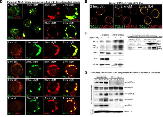 Figure 4. Growth responses of CLL cultures to BCR engagement correlate with kinetics of TCL1 and AKT colocalization to BCR membrane activation complexes. Confocal microscopy on primary cultures was done using a TCL1 monoclonal antibody (fluorescein isothiocyanate, green) in combination with AKT1/2, LYN, ZAP70, or SYK polyclonal antibodies (Cy3, red). Depicted are images from the 2-hour time point (C-E), which best distinguishes pAKT responders and correlated most strongly with the differential growth response seen at 48 hours, as in Figure 3A. (A) In tonsillar B cells, TCL1 and AKT showed a predominantly cytoplasmic distribution without apparent colocalization at baseline (or with CD40L stimulation), but recruitment of TCL1 and AKT to membrane complexes after continuous BCR engagement. AKT/TCL1 colocalization had a punctate pattern at 2 hours, with uniform membrane staining at 24 hours. (B) A representative CLL case with a hyperresponsive growth pattern showed a similar rapid localization of TCL1 and AKT to the membrane as early as 15 minutes after BCR stimulation, with persistence of TCL1-AKT complexes for up to 4 days, including nuclear complexes at these later time points. Apoptotic cells were apparent by 24 hours in those cultures from hyperresponsive cases. (C) BCR-induced TCL1 membrane complexes (left column, single cells) colocalize with the BCR-associated kinases LYN, SYK, and ZAP70 within 2 hours of BCR stimulation (control condition shown in inset with +, #, and *, respectively, marking cells shown in enlarged images). (D) A representative CLL case with dose-dependent growth response to BCR engagement showed delayed but strong recruitment of TCL1 (Cy3, red in top panel) and AKT (Cy3, red) to discrete BCR-containing (CD79a in fluorescein isothiocyanate, green in top panel) membrane activation foci along with TCL1/AKT colocalization (middle row), as well as LYN, ZAP70, and pPKC corecruitment (bottom rows). (E) An absence of TCL1-AKT membrane complexes is noted in CLL with no growth response to BCR engagement. (F) Immunoblots of subcellular fractions (left panel) and subsequent spin column eluates (right panel, molecular weight cutoff > 30 kDa) from the same BCR responder as depicted in Figure 4B confirm the enrichment of phospho-activated AKT and to a lesser degree ZAP70 along with complexed TCL1 (14 kDa for monomeric TCL1) in the membrane compartment at 2 hours of successful BCR stimulation. The altered migration properties of CCR4's membrane associated form served as separation control. (G) Western blot analysis of activation complexes detected by AKT immunoprecipitation was performed after 48 hours of BCR stimulation in a BCR-responsive CLL (left) and a nonresponsive case (right). AKT kinase activity was tested on the immunoprecipitated complexes by assaying phosphorylation of an exogenous GSK3α/β substrate. An α-IgM dose-dependent increase in levels of coimmunoprecipitated pAKT, AKT kinase activity, and complexed ZAP70 was detected in the BCR-responsive case, but not in the nonresponder. Coimmunoprecipitated TCL1 was only detected in the BCR responder. Total TCL1 levels in the lysates from both cultures were similar (bottom panel).