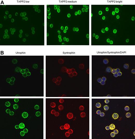 Figure 4. TAPP2, utrophin, and syntrophin are coexpressed in freshly isolated B chronic lymphocytic leukemia cells. B-CLL cells were isolated, fixed, and centrifuged onto glass slides. (A) Samples were stained with rabbit anti-TAPP2, followed by Alexa 488 anti–rabbit secondary antibodies. Note the membrane/cytoplasmic staining of TAPP2 is variable from patient to patient (3 representative patients are shown). (B) Coexpression of utrophin and syntrophin in B-CLL. In the righthand panels, yellow color indicates colocalization of utrophin and syntrophin staining, and blue indicates nuclear staining with DAPI. Two independent patient samples are shown in top and bottom panels. No significant signal was seen when primary antibodies were omitted (controls not shown).