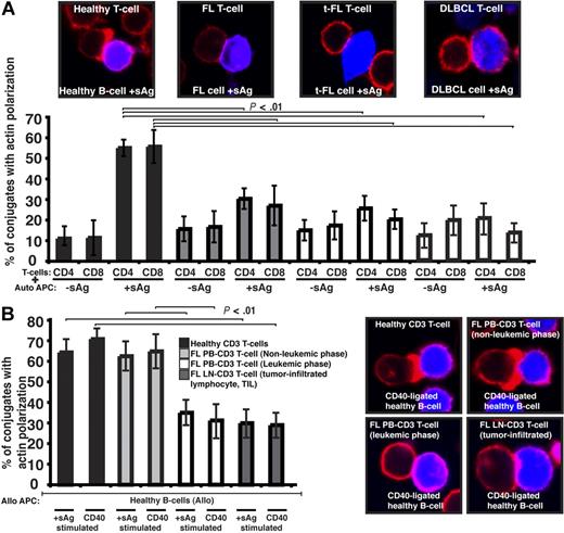 Figure 1. Follicular lymphoma cells exhibit defective T-cell synapse formation with autologous antigen-pulsed tumor cells. (A) Healthy age-matched donor T cells (healthy) or tumor-infiltrated T cells from FL, transformed DLBCL (t-FL), or de novo DLBCL (DLBCL) patients, were allowed to conjugate with autologous healthy B, FL, t-FL, or DLBCL cells, respectively, ± sAg as APCs (CMAC dyed, blue). Conjugates were then fixed and stained with rhodamine phalloidin to detect F-actin (red). Conjugates were selected at random for imaging and were scored for F-actin polarization at the immune synapse. Each dataset is the mean ± SD from 5 independent patient experiments (t-FL and DLBCL, n = 3) with at least 50 conjugates analyzed per experiment. The confocal images shown are CD4+ T cells. (B) Healthy age-matched T cells, nonleukemic-phase FL peripheral blood (PB) T cells, leukemic-phase FL PB T cells, and lymph node (LN) tumor-infiltrated FL T cells were allowed to conjugate with stimulated allogeneic healthy APCs (sAg pulsed or CD40 ligated; CMAC dyed, blue). Conjugates were then fixed and stained with rhodamine phalloidin to detect F-actin (red). Conjugates were selected at random for imaging and were scored for F-actin polarization at the synapse. Each dataset is the mean ± SD from 3 independent patient experiments with at least 50 conjugates analyzed per experiment. Original magnification ×63.