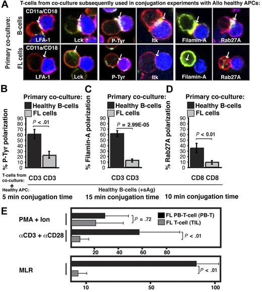 Figure 3. Follicular lymphoma induces defective actin cytoskeletal signaling in previously healthy T cells, and FL TILs exhibit defective downstream functional responses. (A) Healthy CD3+ T cells were cocultured (primary coculture) as described in Figure 2A with either healthy allogeneic B cells (B, top image panels) or allogeneic FL cells (bottom image panels) and subsequently used in conjugation assays with sAg-pulsed third-party allogeneic healthy donor B cells (APCs, blue). T-cell conjugates formed were analyzed by immunofluorescence and confocal microscopy (F-actin was stained red using rhodamine phalloidin). Images shown are representative of evaluation of 250 conjugates from 5 independent experiments for each protein analyzed (stained green), including CD11a/CD18 (LFA-1), Lck, tyrosine-phosphorylated protein (P-Tyr), Itk, Filamin-A, and Rab27A (CD8+ T cells). White arrows denote protein localization. Colocalization of proteins is shown in yellow. (B-D) Quantitative analysis of protein accumulation (green) at the synapse site is shown for (B) P-Tyr, (C) Filamin-A, (D) Rab27A, and LFA-1, Lck, and Itk in supplemental Figure 1. Data represent means ± SD from 5 independent experiments (50 conjugates analyzed per experiment). (E) Mitogenic activity of PB T cells or TILs from FL patients was assessed by thymidine incorporation using PMA and ionomycin, or anti-CD3 and anti-CD28 mAbs. Results are shown as counts per minute. For mixed lymphocyte (MLR), T cells were stimulated with irradiated allogeneic Epstein-Barr virus–transformed lymphoblastoid cell line as stimulator and results shown as the stimulation index. The results shown are the mean + SD of 8 paired (LN and PB) patient samples studied.