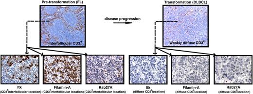 Figure 6. Reduced T-cell numbers and expression of T-cell immunologic synapse proteins are associated with disease transformation in FL. (A) Representative low-power (× 10 magnification) images (top panels) of CD3+ expression on TMA cores from pretransformation (FL) biopsies compared with the patient's disease progression/transformation (DLBCL) biopsies. Note the distinct strong interfollicular CD3+ expression on FL biopsy compared with weakly diffuse expression on the patient's transformed biopsy. Representative high-power (×40 magnification) images (bottom panels) of interfollicular (CD3+ location) Itk, Filamin-A, and Rab27A expression on FL biopsies compared with weak diffuse expression of these T-cell synapse signature proteins on the patient's transformed biopsies. Quantitative analysis of expression and percentage of positive cells for these synapse signature proteins comparing total FL biopsy core area (sum of intrafollicular and interfollicular location expression) to total DLBCL biopsy core area is shown in supplemental Figures 5–8.