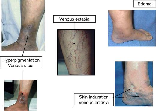 Figure 1. Postthrombotic syndrome.