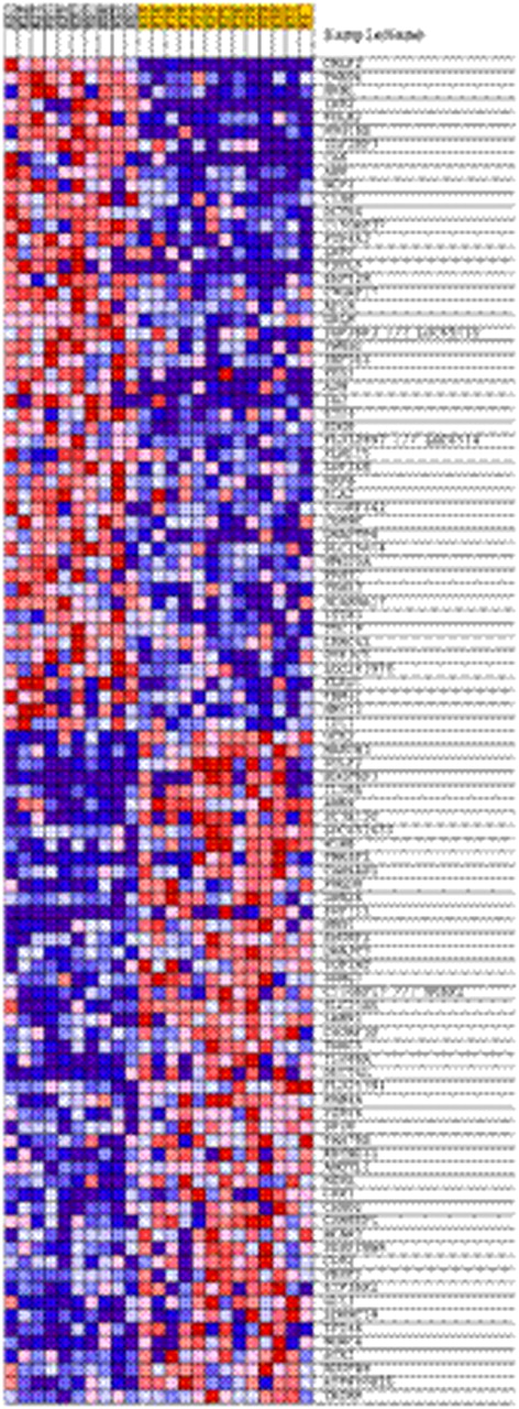 Figure 1. Gene expression signature of top differentially expressed genes in Down syndrome (DS) acute lymphoblastic leukemia (ALL) cases with high versus low CRLF2 expression. Each column indicates a case, with CRLF2-high cases depicted in gray and CRLF2-low cases in gold. Each row indicates one of the top 100 differentially expressed genes as determined by Gene Set Enrichment Analysis.