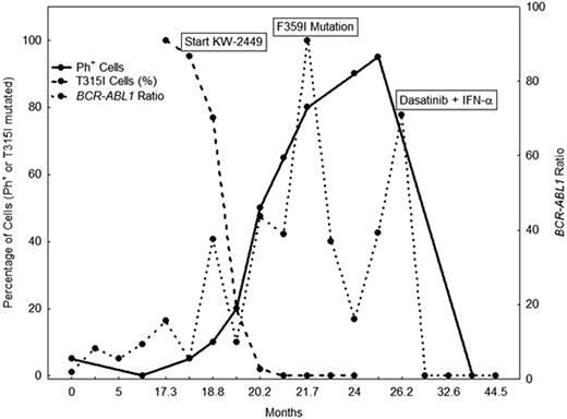 Figure 1. Serial Monitoring of Ph+ Cells, T315I Cells and BCR-ABL1/ABL1 Ratio