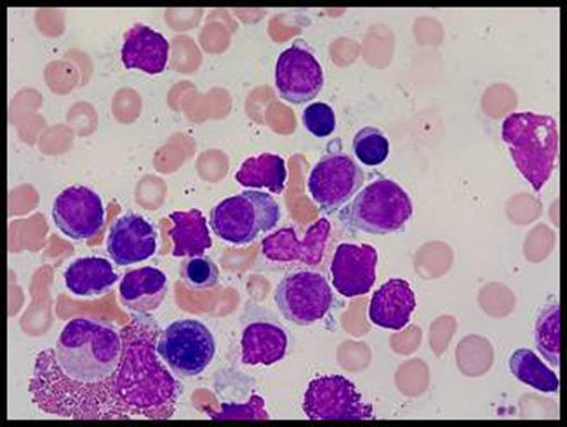 Figure 1:. Representative bone marrow aspirate of a patient after 6 months of treatment with lenalidomide showing lymphocytes with plasmacytoid features.