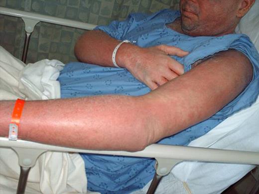 Figure 1. SEQ – Imatinib induced generalized erythema, pustular rash, and skin sloughing developed five days into treatment.