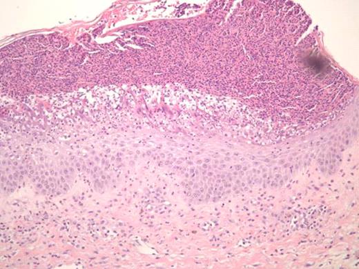 Figure 2. SEQ - skin biopsy revealing subcorneal pustular dermatosis