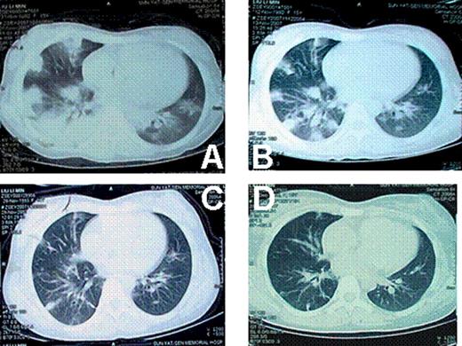 Fig 1. lung CT of case 1. A: when the pulmonary infection began; B: 2 weeks later; C: 4 weeks later; D: 8 weeks later.
