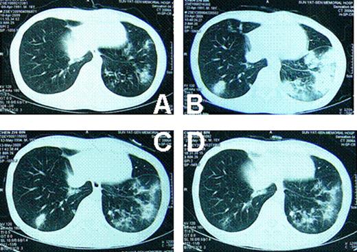 Fig 2. lung CT of case 1. A: when the pulmonary infection began; B: 2 weeks later; C: 5 weeks later; D: 7 weeks later.