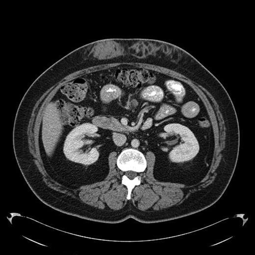 Fig 1. Amyloid infiltration in subcutaneous tissue of upper abdomen at insulin injection site
